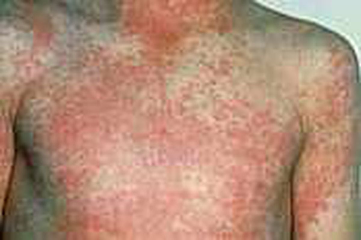 scarlet-fever-has-struck-at-schools-guernsey-press