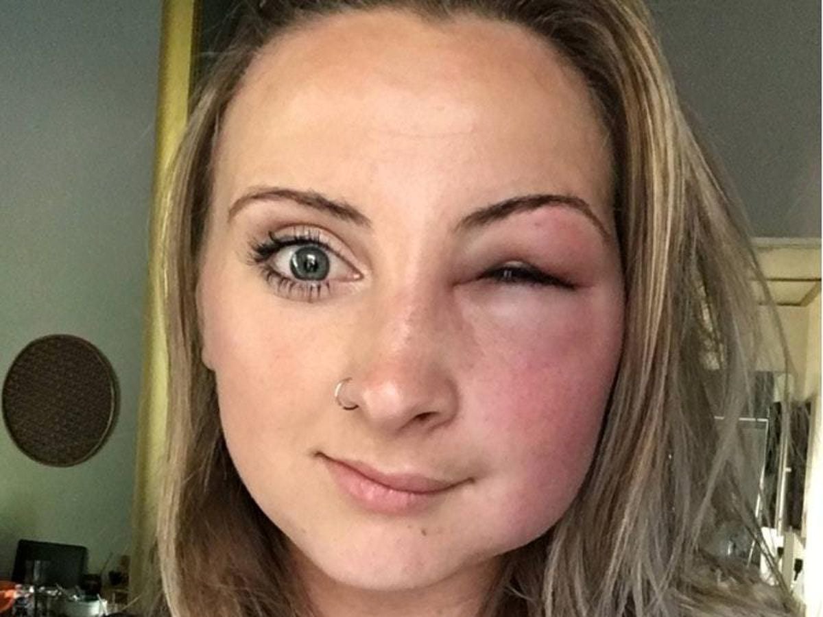 Here’s What Happens If You Get Stung By A Bee Near Your Eye | Guernsey ...