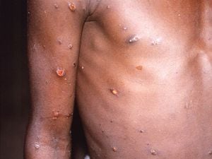 Monkeypox could have ‘massive impact’ on sexual health services, doctor warns