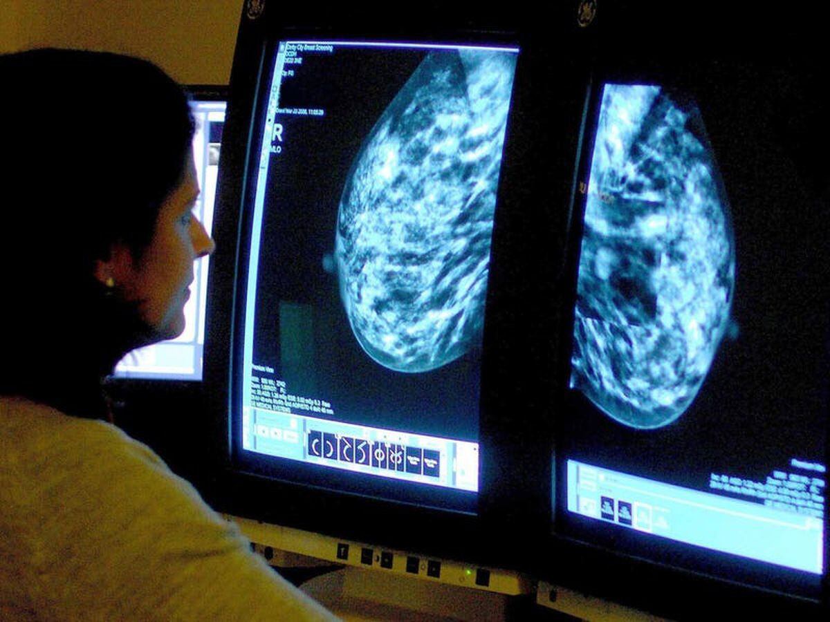 AI model may predict if aggressive breast cancer will spread, research suggests