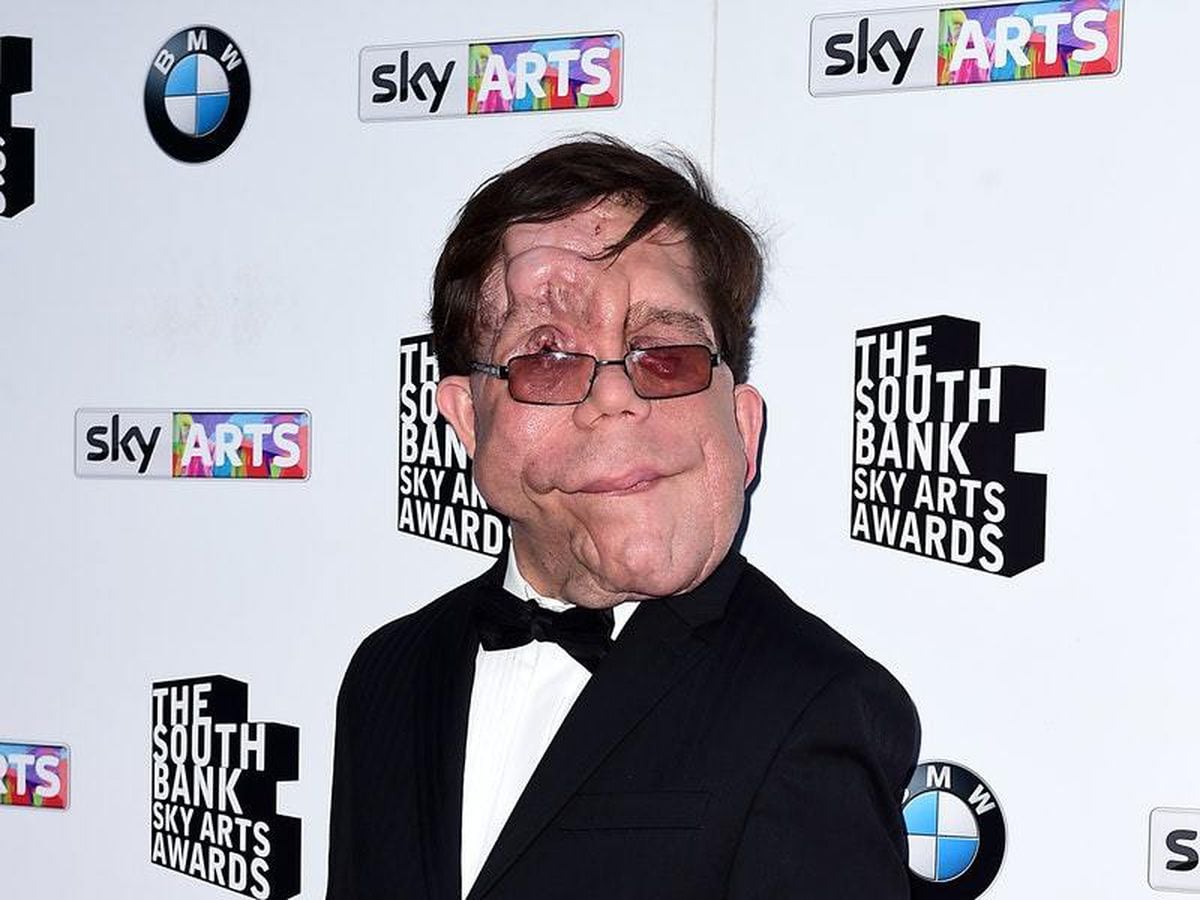 I got sick of being asked why I wasn’t wearing a mask, says actor Adam Pearson Guernsey Press