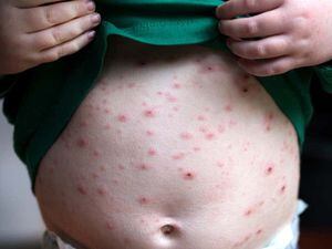 Introducing routine chickenpox jabs for children ‘could end risky pox parties’