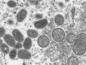 Case of monkeypox reported in Massachusetts man who visited Canada